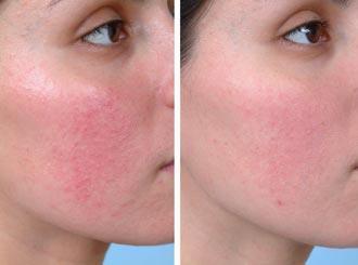 Rosaceabehandeling met niacinamide